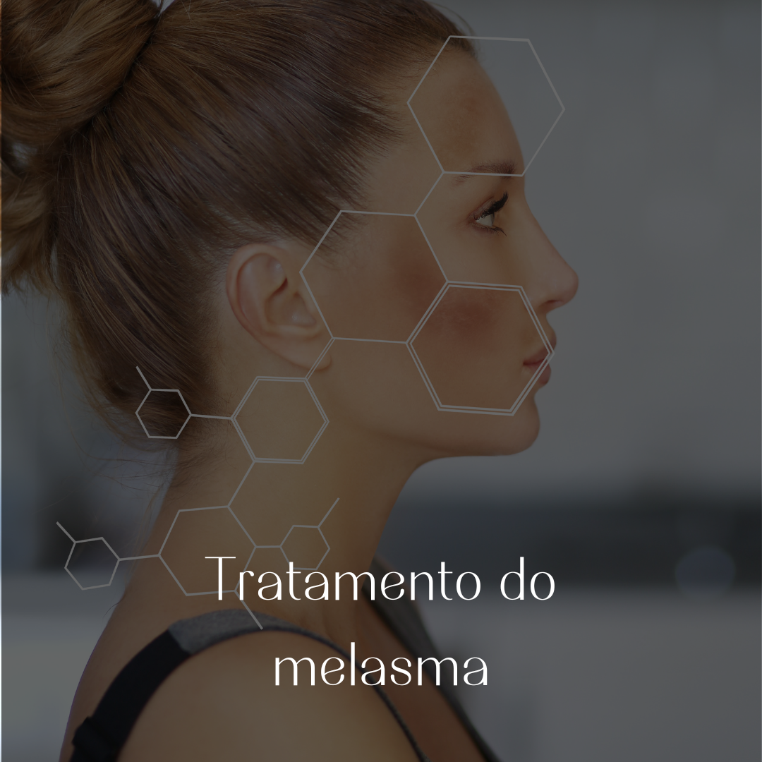 melasma